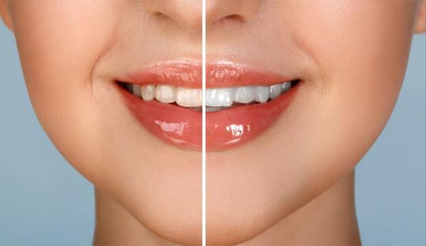 برای سفید کردن دندان ها درمان خانگی یا حرفه ای بهتر است؟